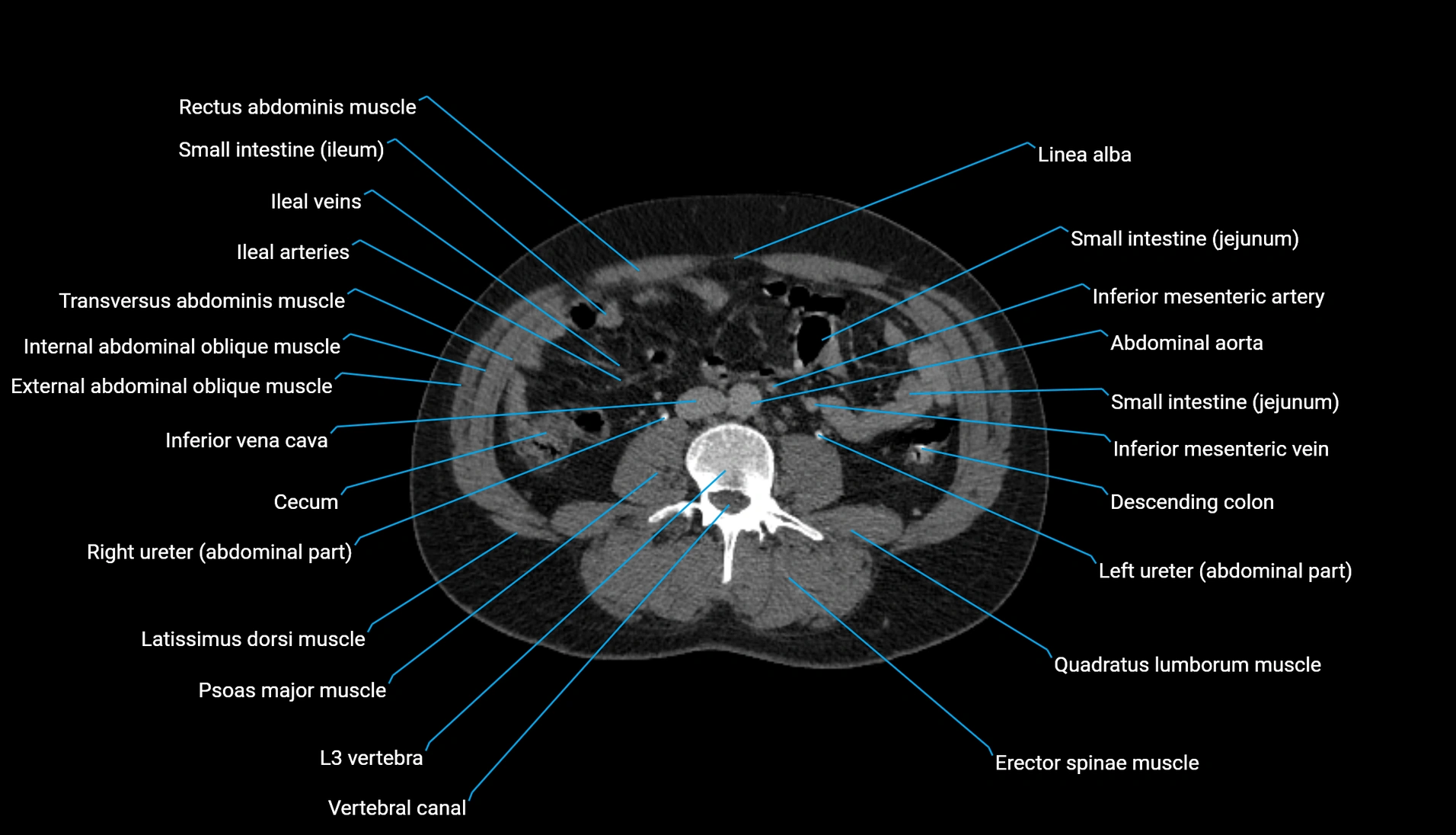 CT urogram axial cross sectional anatomy  labelled radiology image-00136.webp